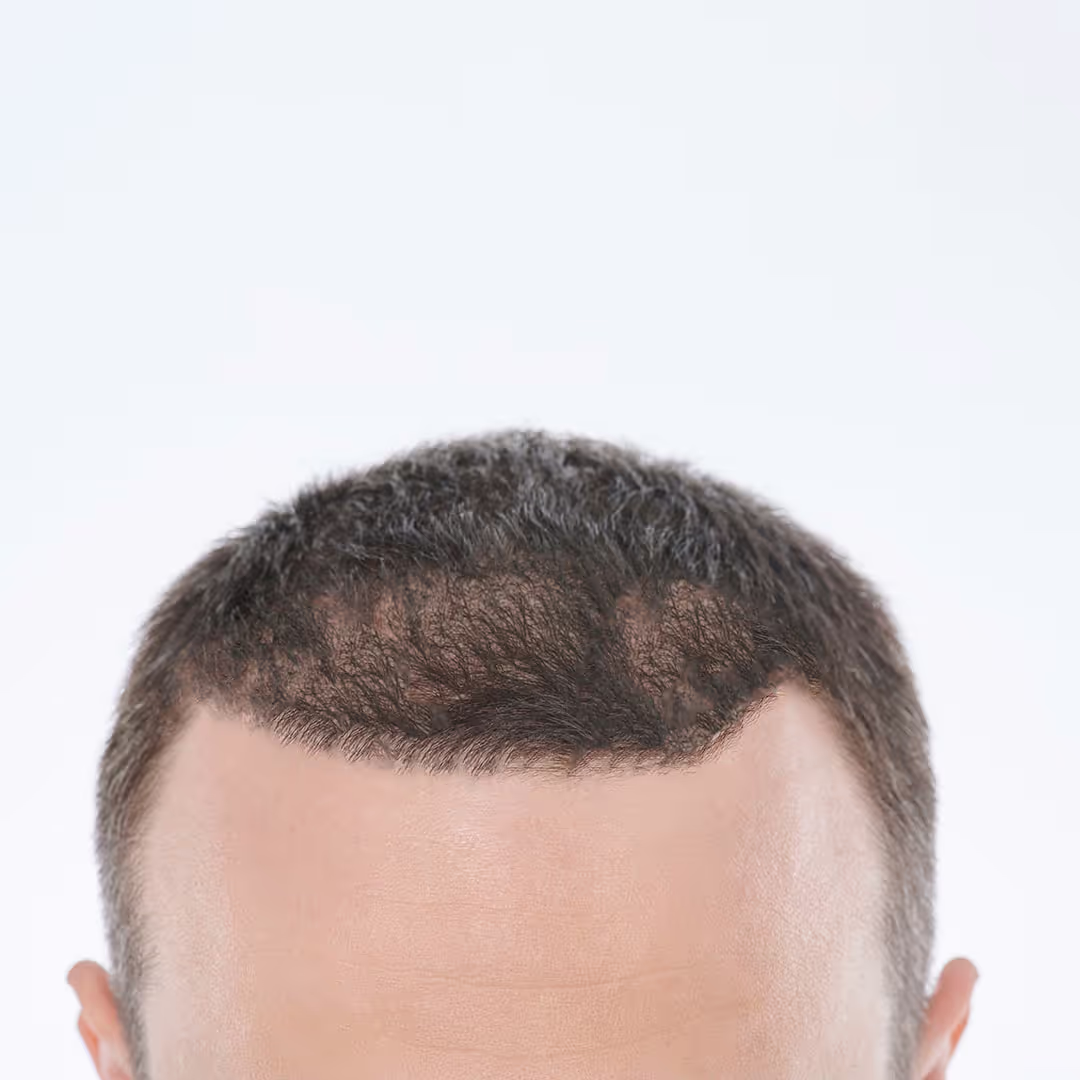 Dieser Mann hat sichtlich keinen Haarausfall mehr.
