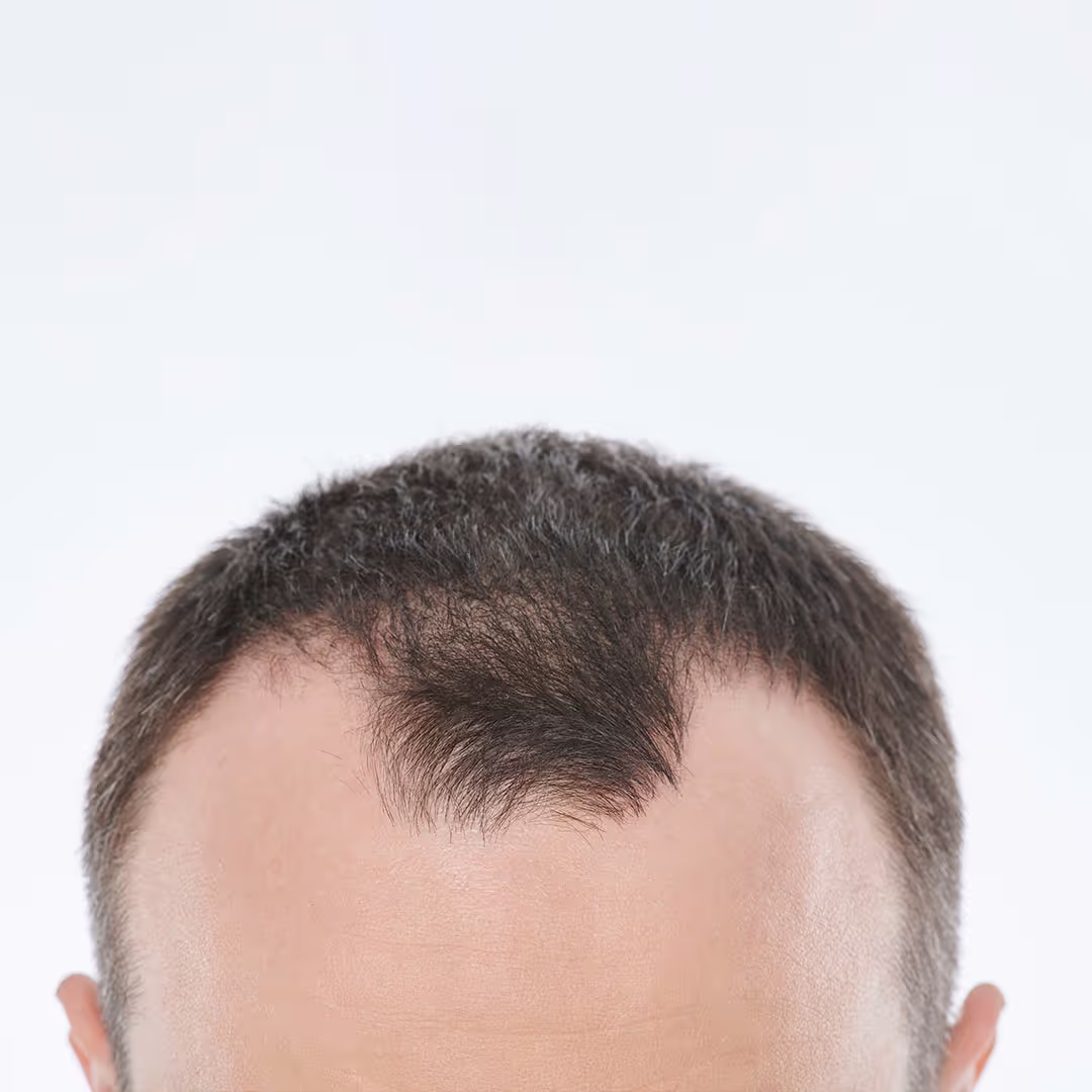 Ein Kopf von einem Mann der sichtlich an Haarausfall leidet. Die Geheimratsecken sind bereits sehr weit fortgeschritten.