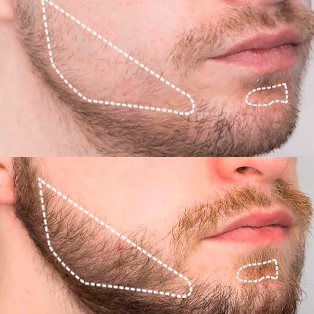 Freie Bartstellen werden Strichliert dargestellt, um den Bereich für Barttransplantation zu kennzeichnen.