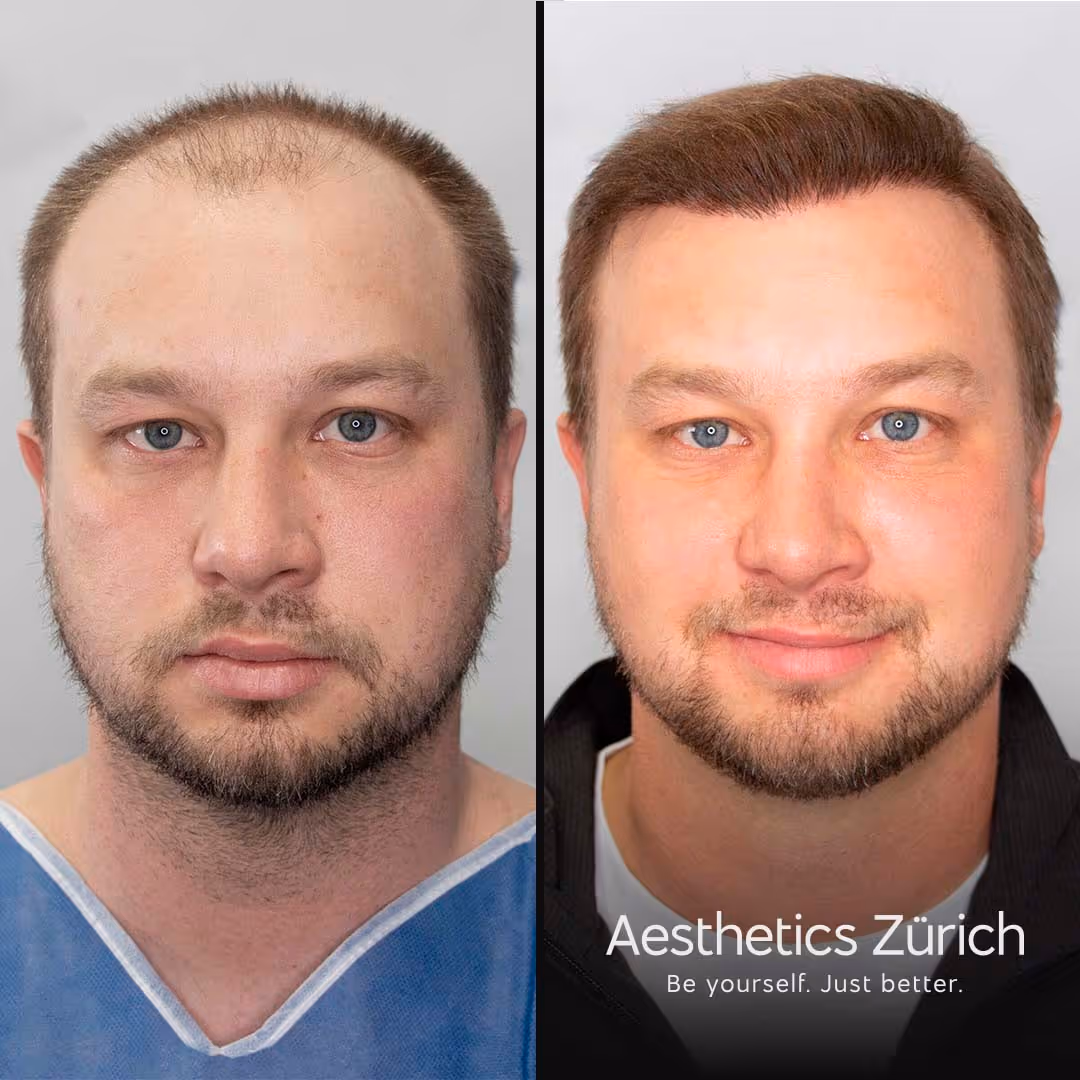 Ein weiterer Patient der sichtlich happy mit der Veränderung seiner dichten Haare ist.
