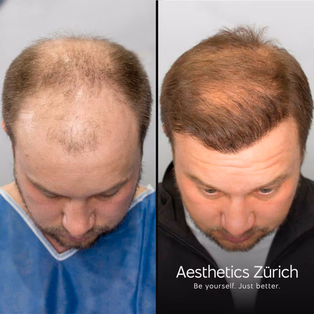 Karli Stelle am Oberkopf die nun aber mit Haaren zugewachsen ist.