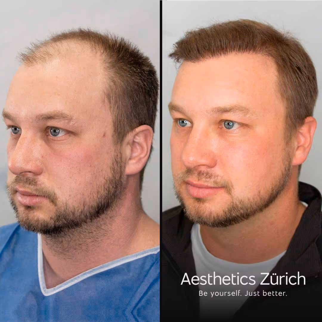 Ein Foto von einem Kunden das beweist dass die Haartransplantation ein voller Erfolg war.