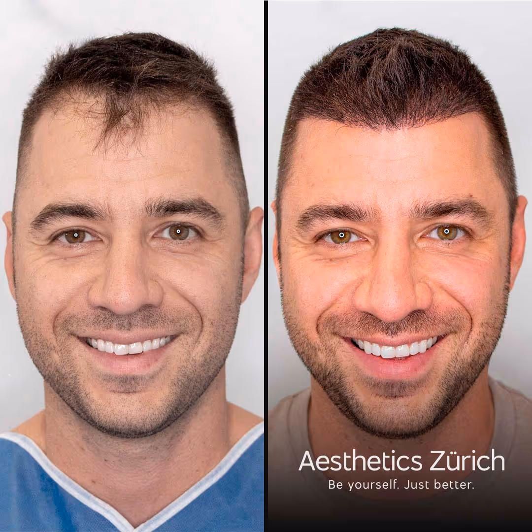 Ein Patient von Klinik Ästhetik Zürich lächelt glücklich über die neuen Haare in die Kamera.