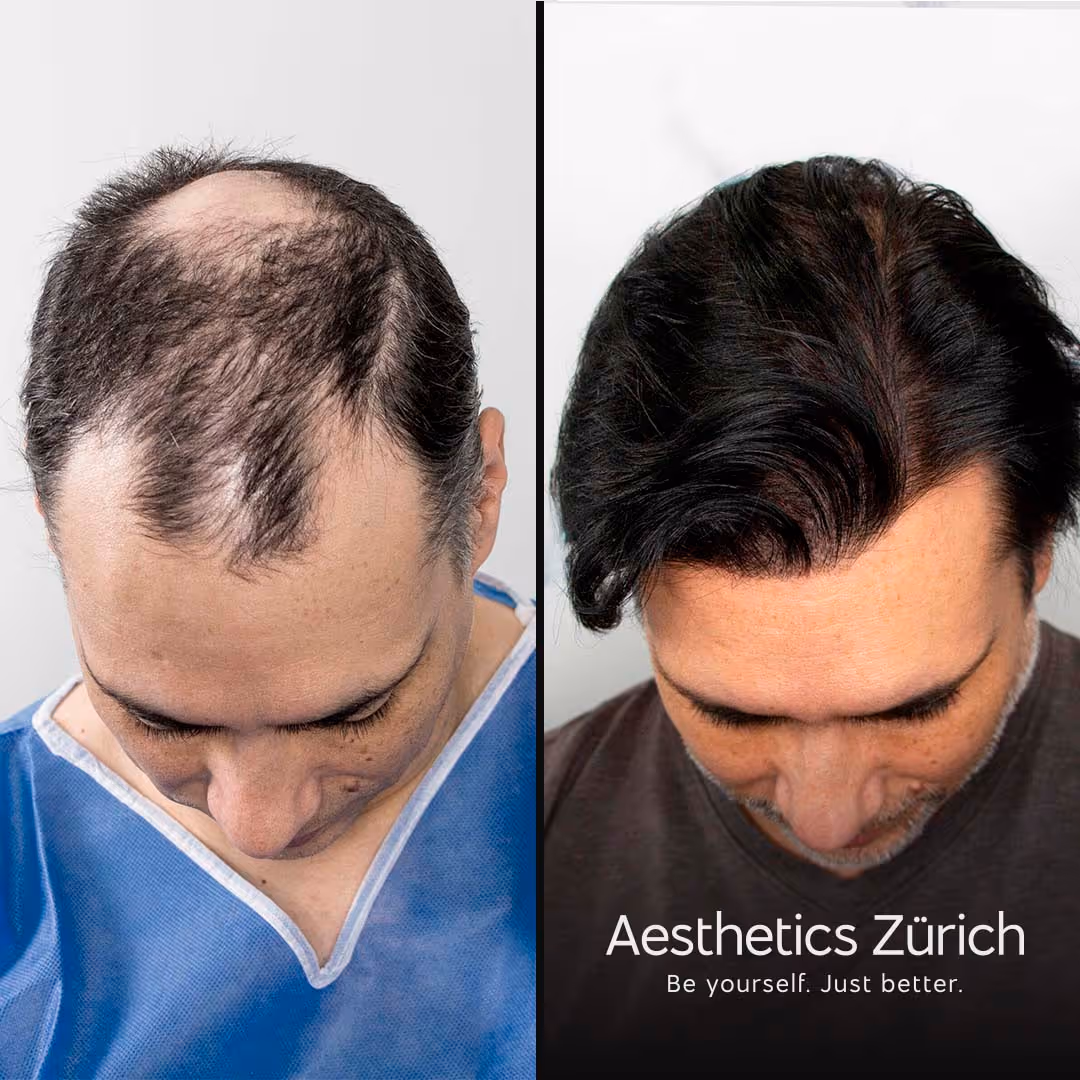 Vorher kaum Haare am Oberkopf. Danach lange dunkle schöne Haare.