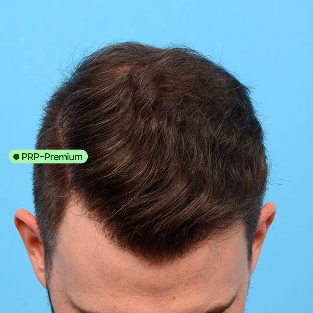 Schön zugewachsene Haare am Oberkopf nach einer PRP Behandlung.