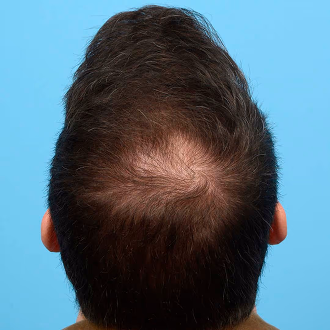 Ein Bild vor der PRP Behandlung Kahle Stellen mit wenig Haar.
